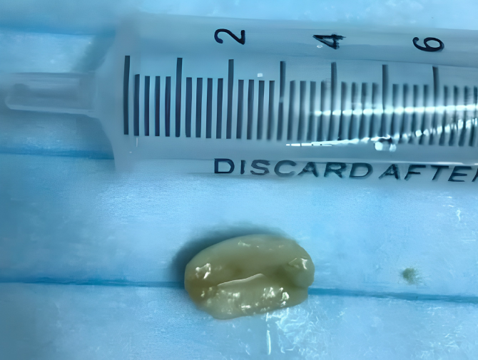 A persistent cough, thought to be bronchitis, turned out to be caused by a peanut that had "wandered" into the lungs.